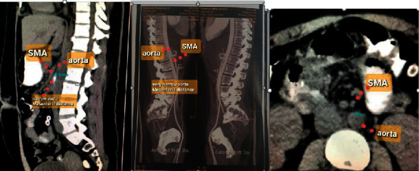 Superior Mesenteric Artery Syndrome Managed with Laparoscopic Duodenojejunostomy.