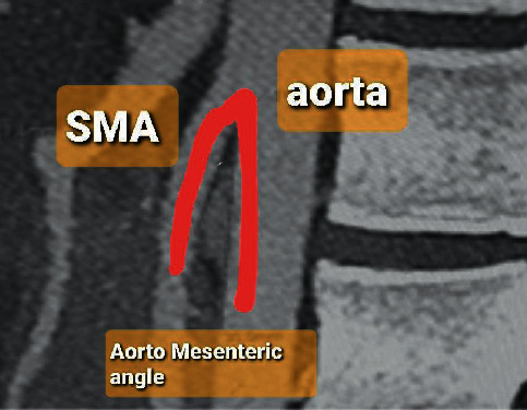 Superior Mesenteric Artery Syndrome Managed with Laparoscopic Duodenojejunostomy.