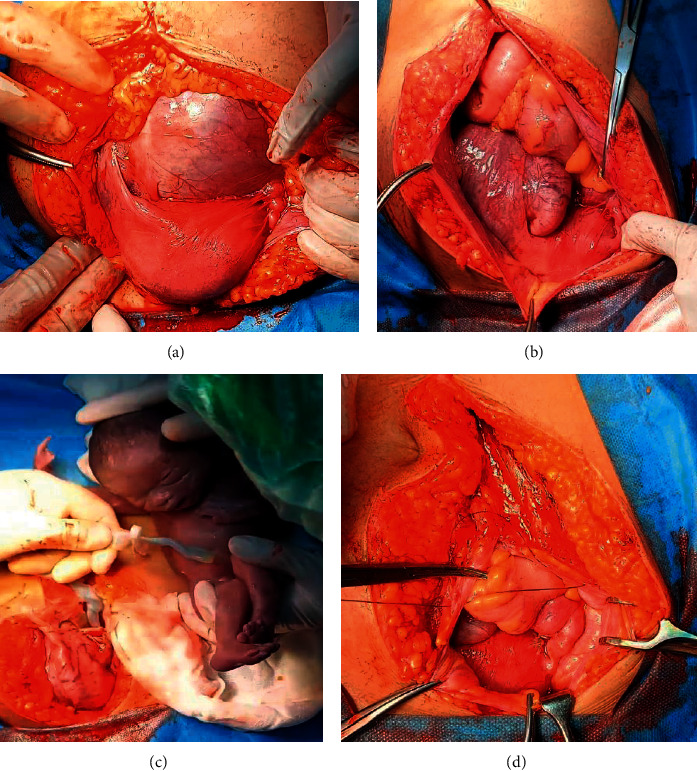 Biopsychosocial Approach for Conservative Management of Abdominal Pregnancy in Previously Infertile Mother.