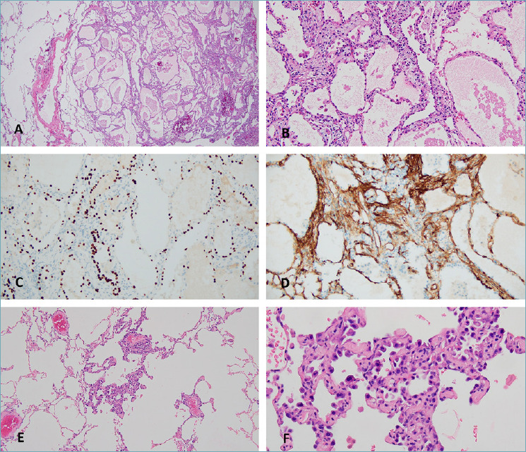 Alveolar adenoma and coexisting atypical adenomatous hyperplasia: a case report and literature review.