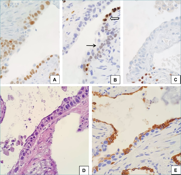 Pulmonary squamous cell carcinoma with a lepidic-pagetoid growth pattern.