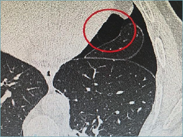 An unexpected cause of recurrent pneumothorax.