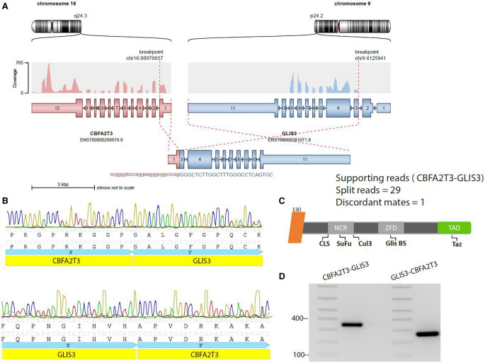 Detection of a GLIS3 fusion in an infant with AML refractory to chemotherapy.