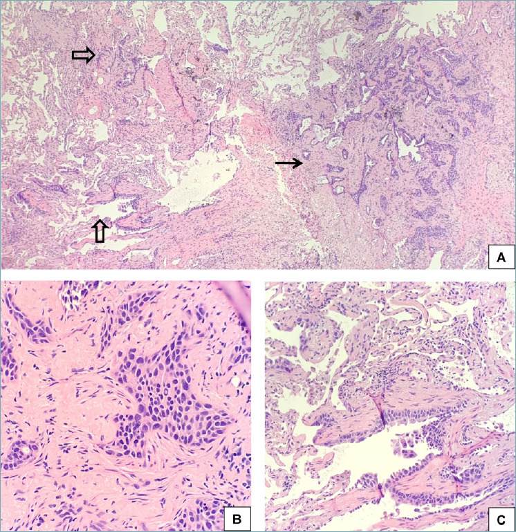 Pulmonary squamous cell carcinoma with a lepidic-pagetoid growth pattern.