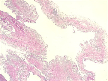 An unexpected cause of recurrent pneumothorax.