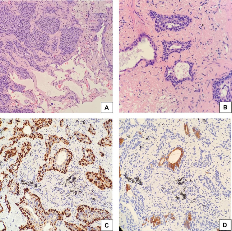 Pulmonary squamous cell carcinoma with a lepidic-pagetoid growth pattern.