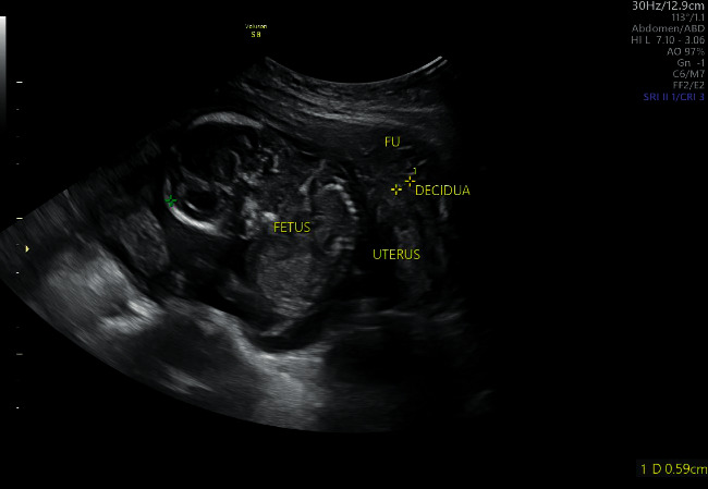 Biopsychosocial Approach for Conservative Management of Abdominal Pregnancy in Previously Infertile Mother.