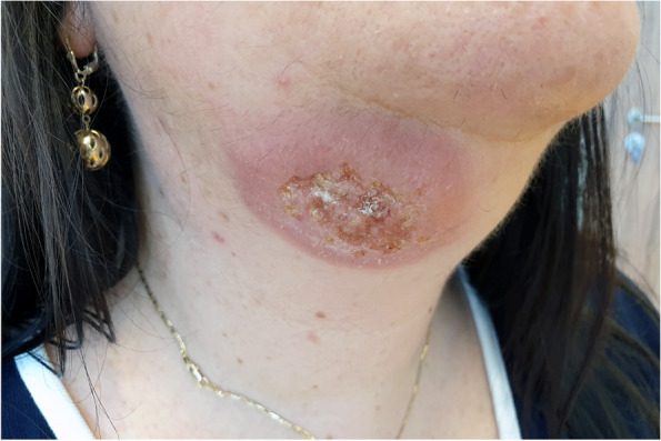 Misdiagnosis and inappropriate treatment of cutaneous leishmaniasis: a case report.