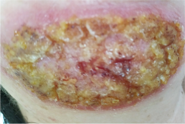 Misdiagnosis and inappropriate treatment of cutaneous leishmaniasis: a case report.