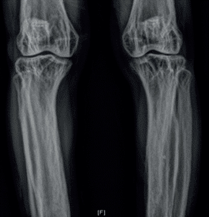 Focal Dermal Hypoplasia with Osteopathia Striata.