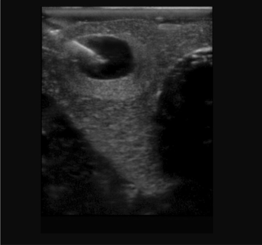 Battle of the axes: simulation-based assessment of fine needle aspiration biopsies for thyroid nodules.