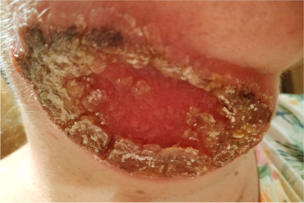 Misdiagnosis and inappropriate treatment of cutaneous leishmaniasis: a case report.