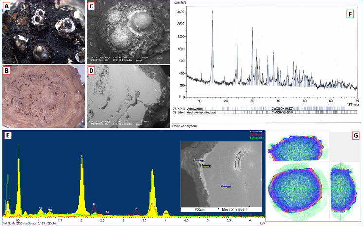 Multidisciplinary investigation of an ancient renal stone in a mummy from Popoli, central Italy.