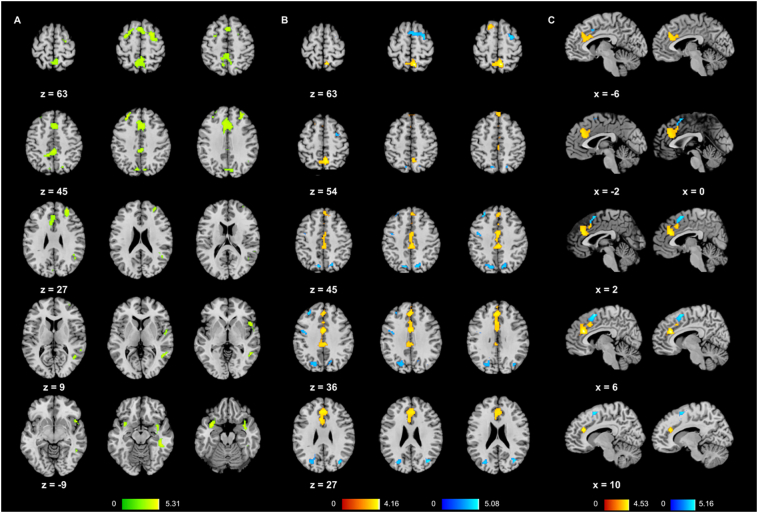 Functional neurodevelopment of working memory in early-onset schizophrenia: A longitudinal FMRI study