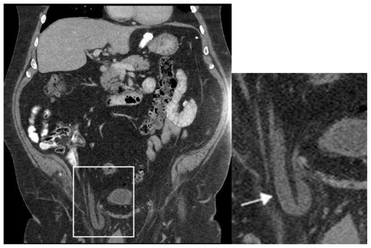 Ureteral Inguinal Herniation.