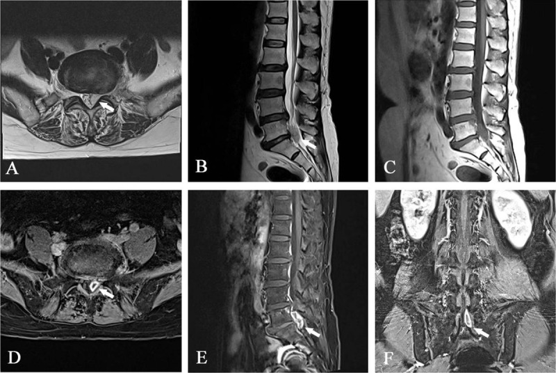 MR Imaging of Migrated Nucleus Pulposus after Collagenase Injection of Lumbar Disc Herniation: A Case Report.