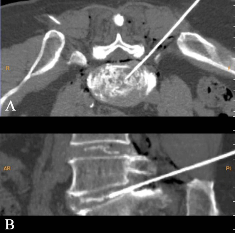 MR Imaging of Migrated Nucleus Pulposus after Collagenase Injection of Lumbar Disc Herniation: A Case Report.