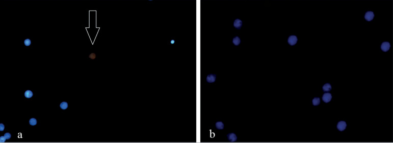 p63 expression in granulosa-luteinized cells of infertile patients with peritoneal endometriosis submitted to in vitro fertilization.