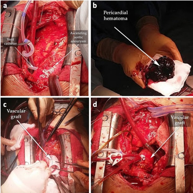 Right Heart Failure as an Atypical Presentation of Chronic Type a Aortic Dissection - Multimodality Imaging for Accurate Diagnosis and Treatment. A Case Report and Mini-review of Literature.