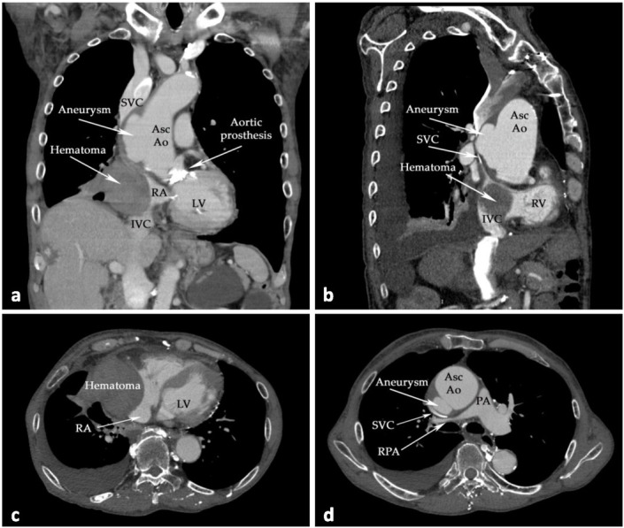 Right Heart Failure as an Atypical Presentation of Chronic Type a Aortic Dissection - Multimodality Imaging for Accurate Diagnosis and Treatment. A Case Report and Mini-review of Literature.