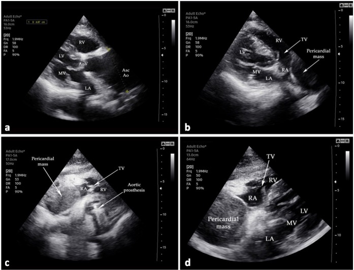 Right Heart Failure as an Atypical Presentation of Chronic Type a Aortic Dissection - Multimodality Imaging for Accurate Diagnosis and Treatment. A Case Report and Mini-review of Literature.