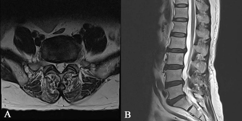 MR Imaging of Migrated Nucleus Pulposus after Collagenase Injection of Lumbar Disc Herniation: A Case Report.