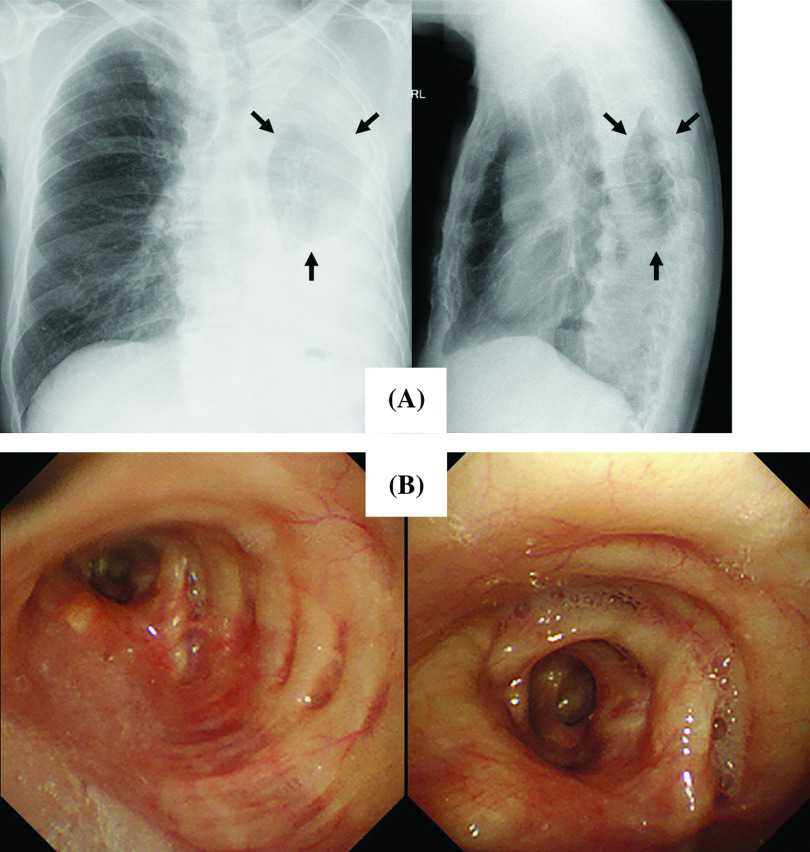 Extended Bronchoplasty Anastomosed between the Left Main and the Superior Segmental Bronchi for Locally Advanced Left Upper Lobe Lung Cancer with Invasion of the Basal Segment.