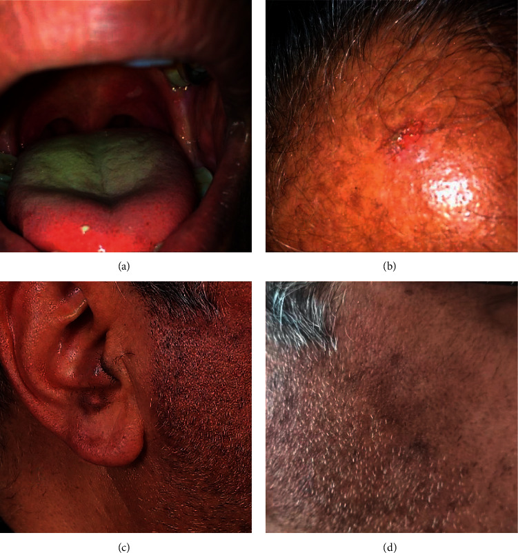 Coexistence of Pemphigus Vulgaris and Lichen Planus following COVID-19 Vaccination.