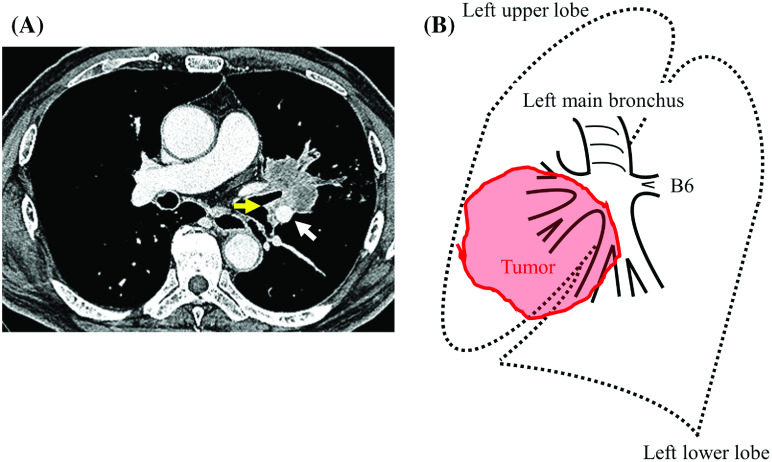 Extended Bronchoplasty Anastomosed between the Left Main and the Superior Segmental Bronchi for Locally Advanced Left Upper Lobe Lung Cancer with Invasion of the Basal Segment.