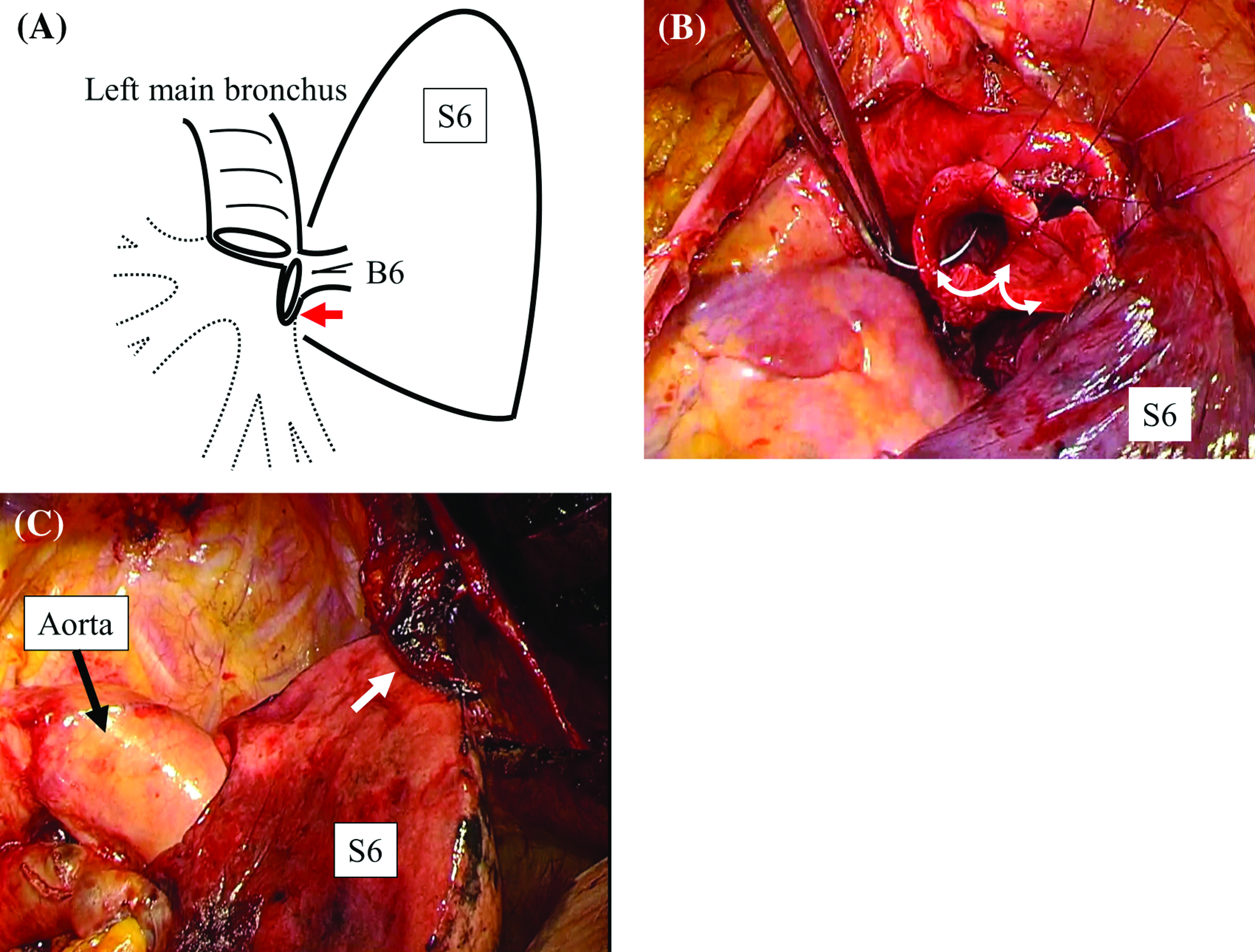 Extended Bronchoplasty Anastomosed between the Left Main and the Superior Segmental Bronchi for Locally Advanced Left Upper Lobe Lung Cancer with Invasion of the Basal Segment.