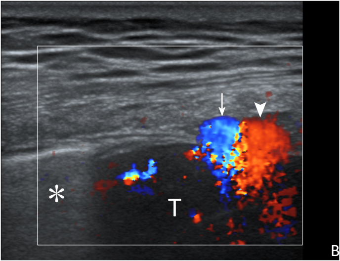 Efficacy of contrast-enhanced ultrasound-guided percutaneous core needle biopsy in anterior mediastinal masses