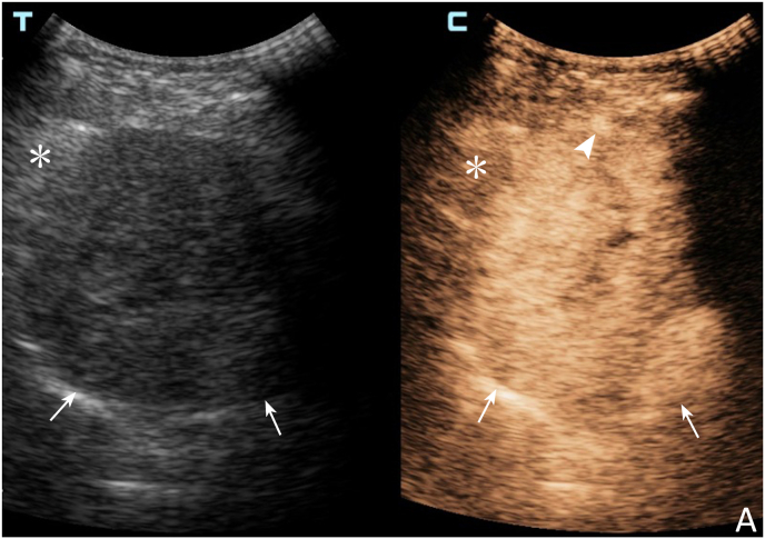 Efficacy of contrast-enhanced ultrasound-guided percutaneous core needle biopsy in anterior mediastinal masses