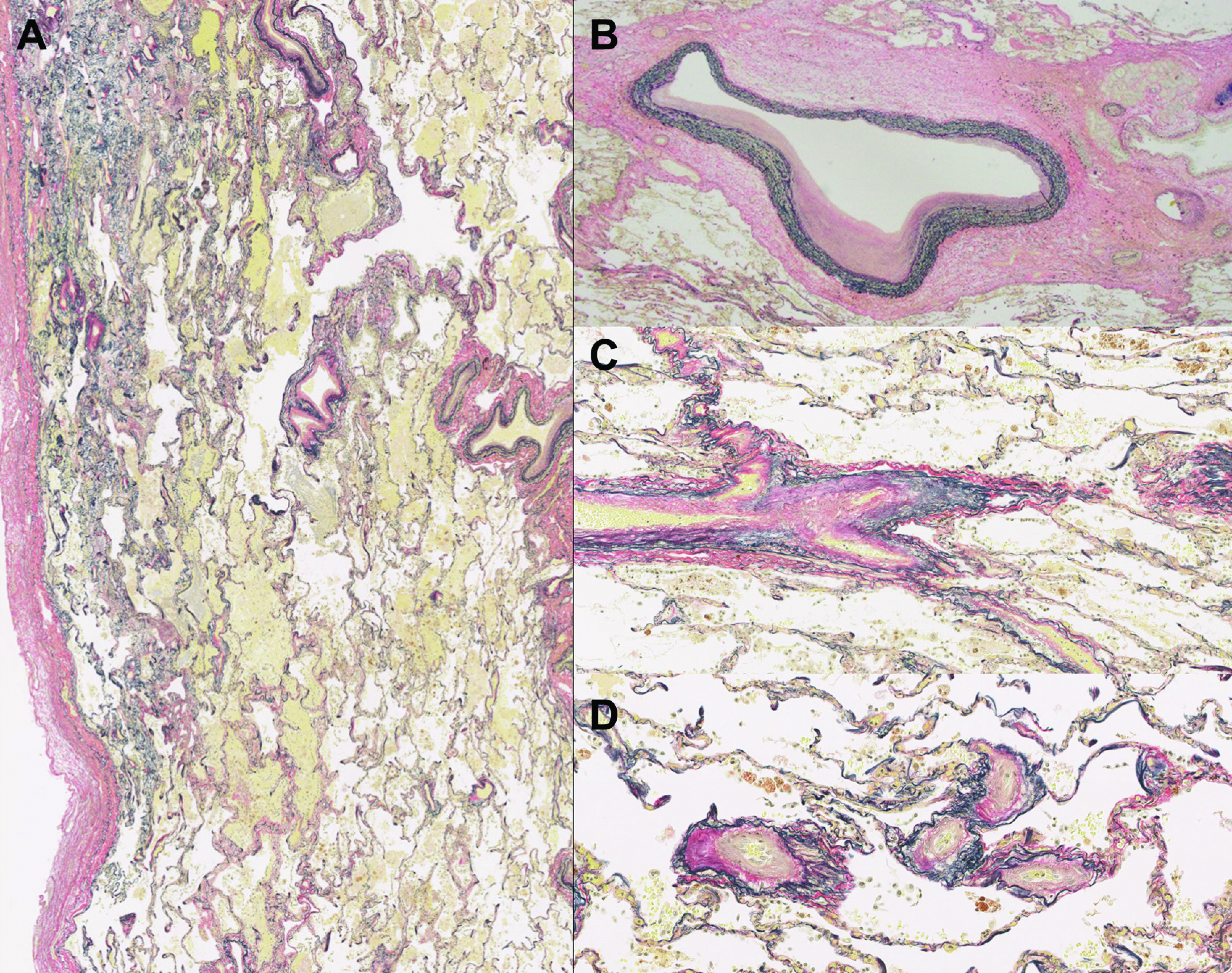 Exacerbation of Secondary Pulmonary Hypertension by Flat Chest after Lung Transplantation.