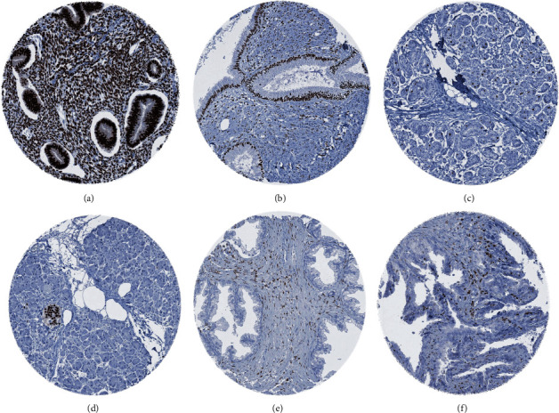 Diagnostic and Prognostic Impact of Progesterone Receptor Immunohistochemistry: A Study Evaluating More Than 16,000 Tumors.