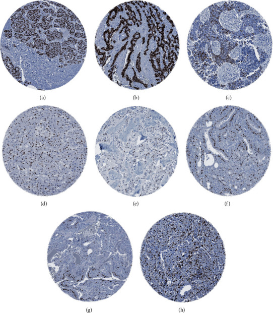 Diagnostic and Prognostic Impact of Progesterone Receptor Immunohistochemistry: A Study Evaluating More Than 16,000 Tumors.