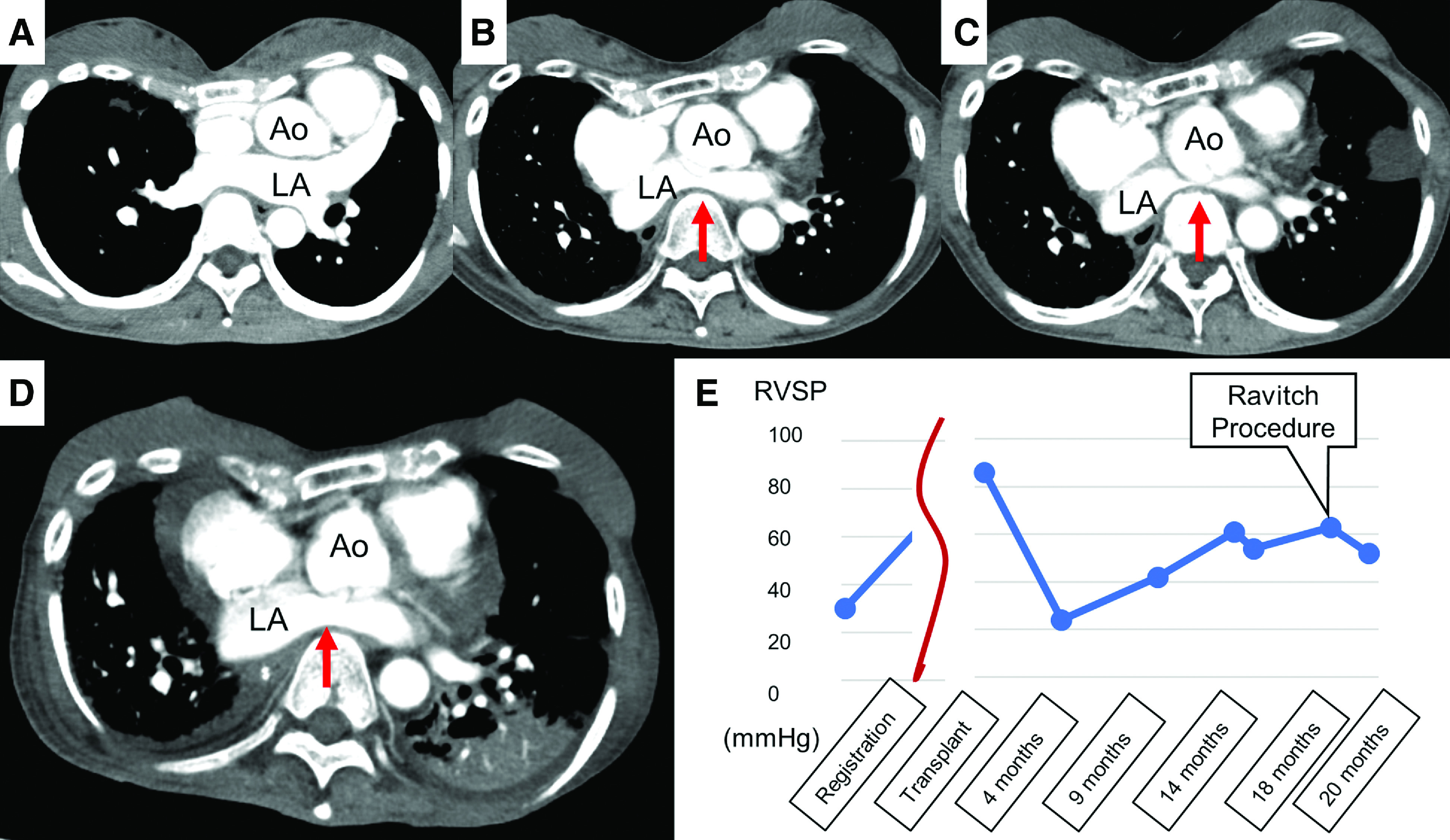 Exacerbation of Secondary Pulmonary Hypertension by Flat Chest after Lung Transplantation.