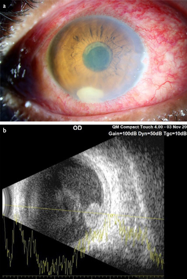 Unilateral Endogenous Bacterial Endophthalmitis Post-Coronavirus Disease-19 in an Healthy Asian Indian Male.