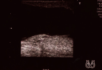 Colon Cancer Metastasis to the Right Testis: Case Report and Review of Literature.