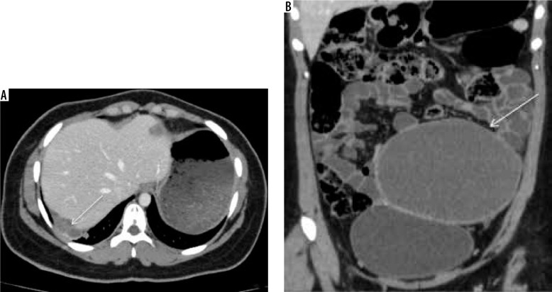 Magnetic resonance imaging of endometriosis: a common but often hidden, missed, and misdiagnosed entity.