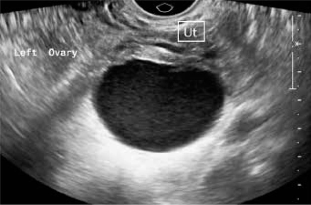 Magnetic resonance imaging of endometriosis: a common but often hidden, missed, and misdiagnosed entity.