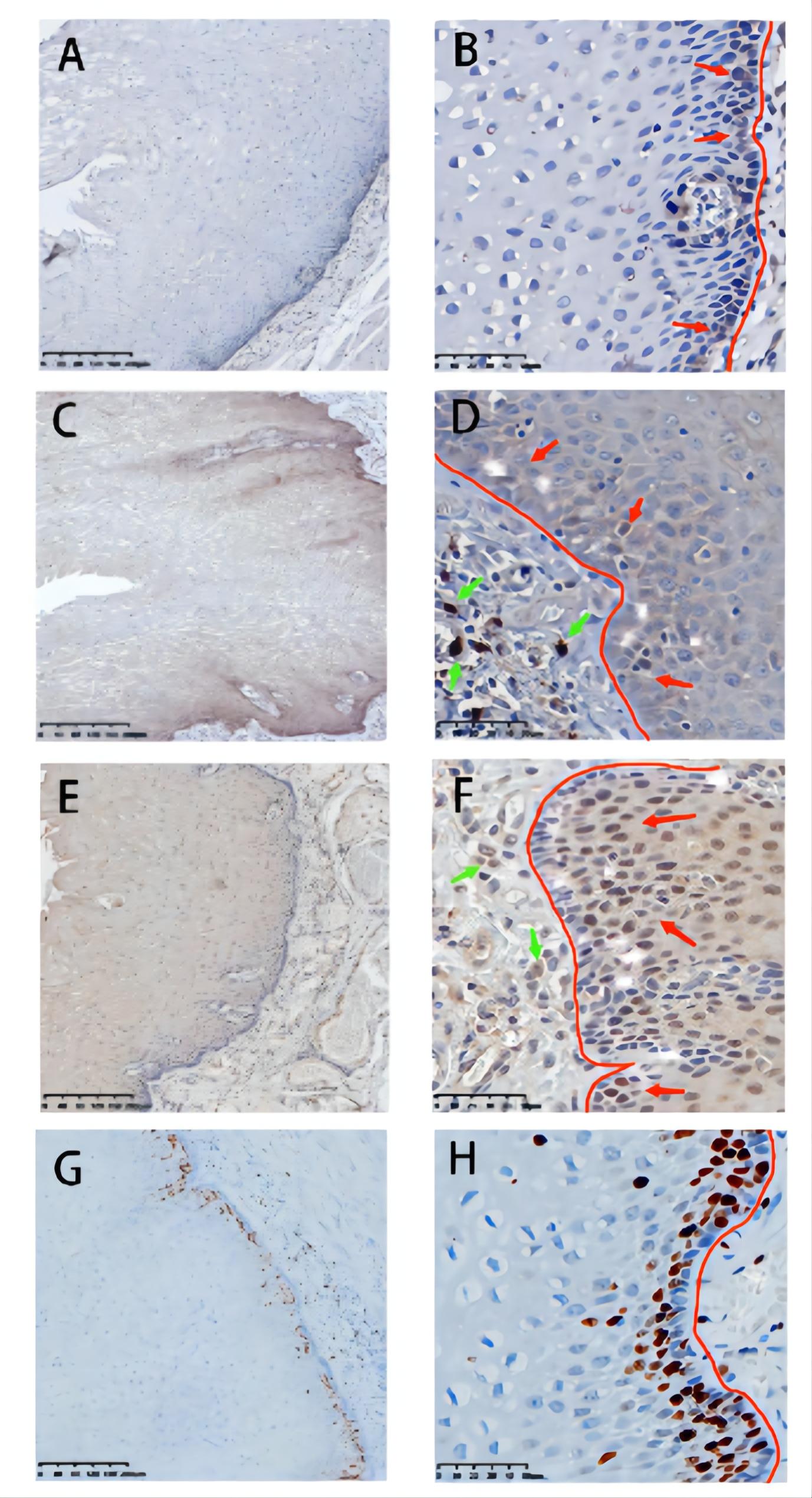 Prognostic Value of GPNMB, EGFR, p-PI3K, and Ki-67 in Patients with Esophageal Squamous Cell Carcinoma.