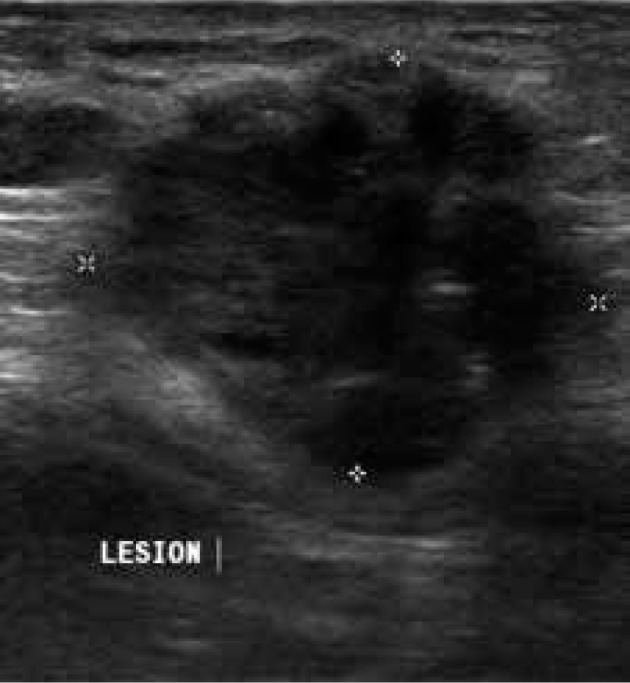 Magnetic resonance imaging of endometriosis: a common but often hidden, missed, and misdiagnosed entity.