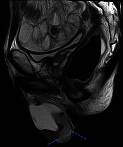 Colon Cancer Metastasis to the Right Testis: Case Report and Review of Literature.