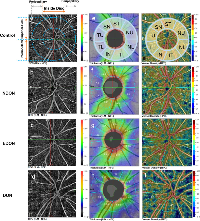 Peripapillary structural and microvascular alterations in early dysthyroid optic neuropathy.