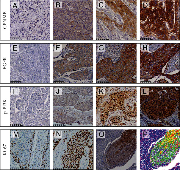 Prognostic Value of GPNMB, EGFR, p-PI3K, and Ki-67 in Patients with Esophageal Squamous Cell Carcinoma.