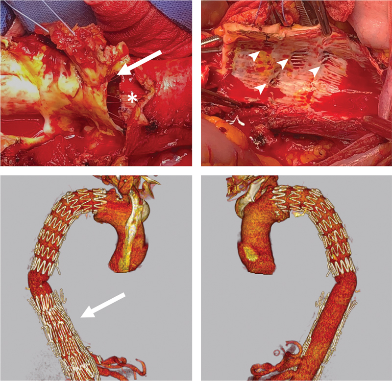 Open Thoracoabdominal Aortic Procedures following Endovascular Intervention.