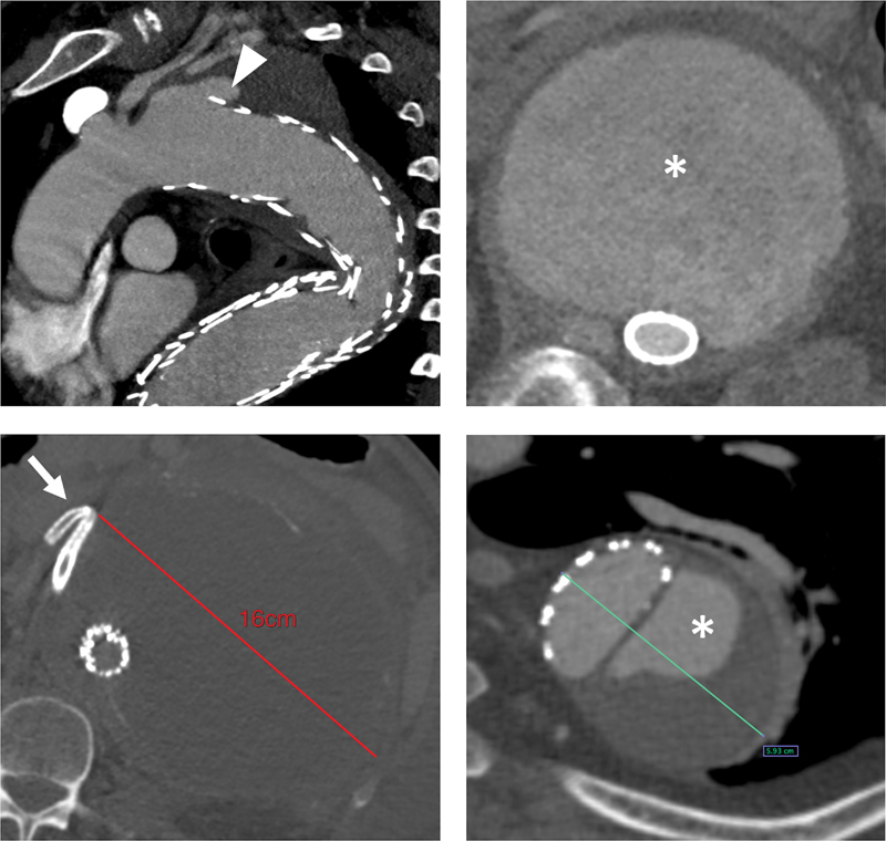 Open Thoracoabdominal Aortic Procedures following Endovascular Intervention.