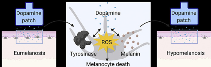 Leukoderma Induced by Rotigotine Patch, a Transdermal Dopamine Agonist.