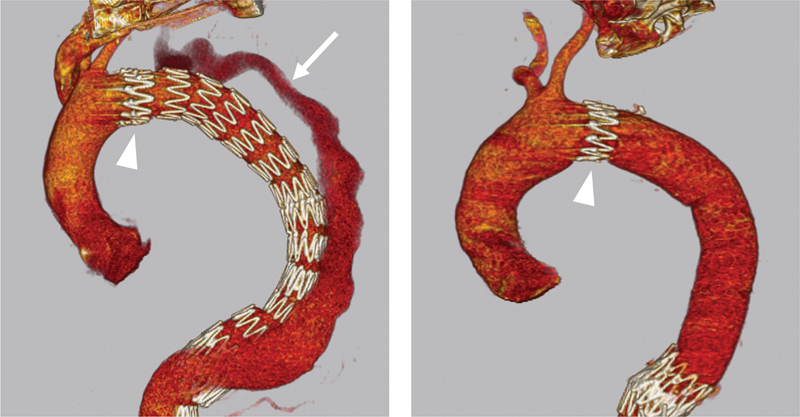 Open Thoracoabdominal Aortic Procedures following Endovascular Intervention.