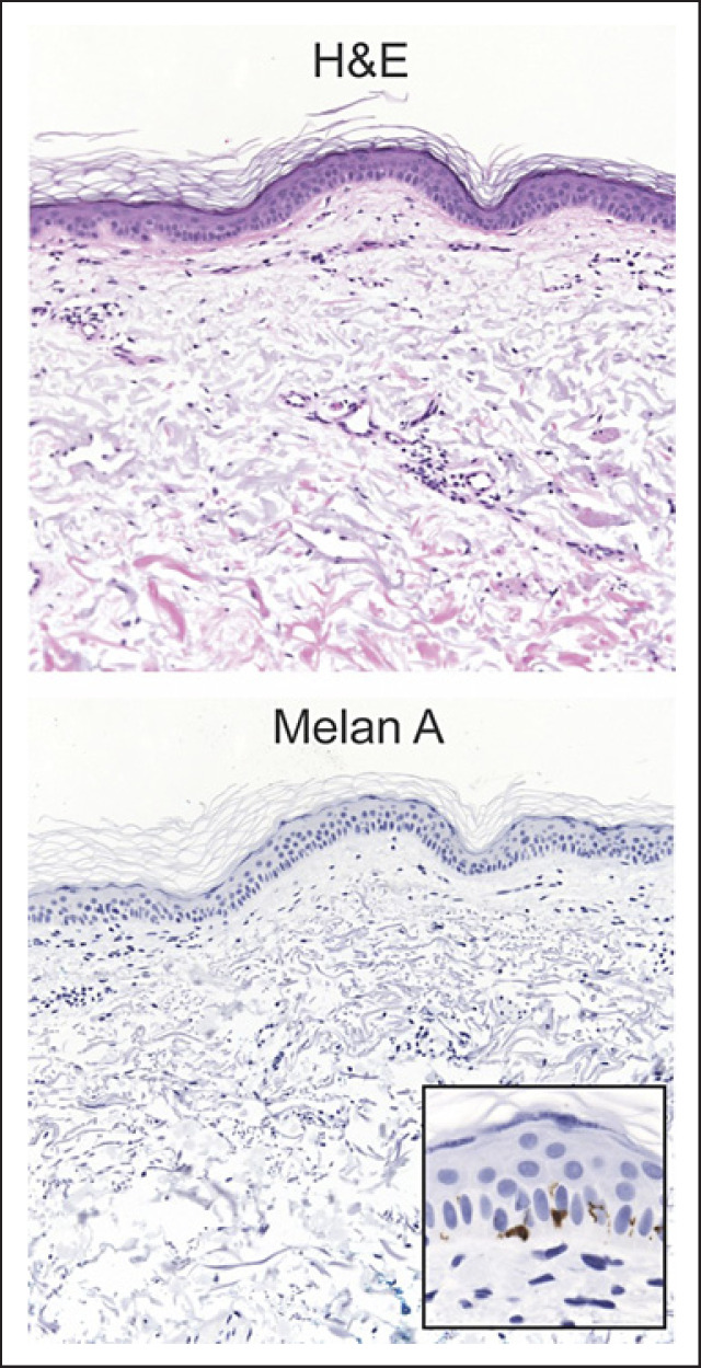 Leukoderma Induced by Rotigotine Patch, a Transdermal Dopamine Agonist.